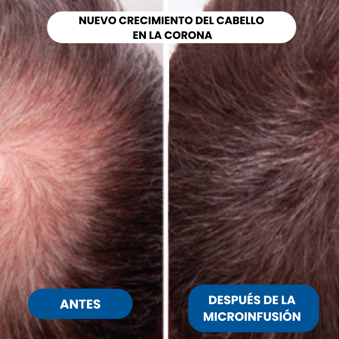 Microinfusión de péptidos para el crecimiento del cabello.