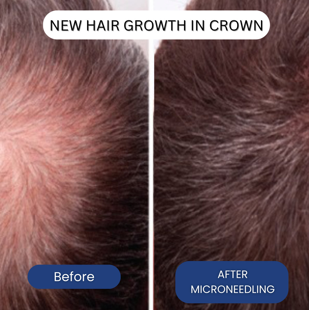 Micro-Infusion Peptide System For Hair Regrowth