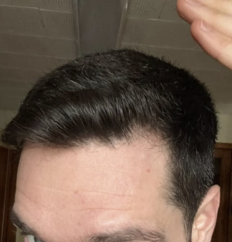 Cabello de tim antes de usar Peptonix