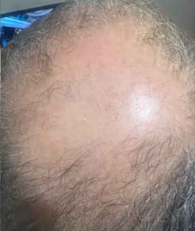 Cabello de daniel antes de usar Peptonix